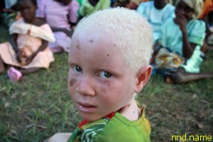  Альбиносы в Танзании