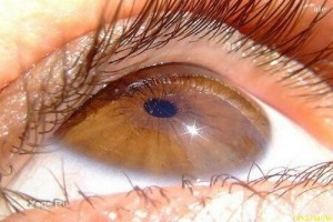 Японцы лечат заболевание глаз стволовыми клетками