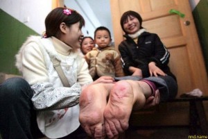 Китаянка с перевернутыми стопами шокировала врачей
