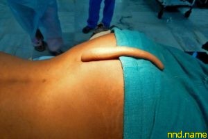 Хирурги удалили индийцу 18-сантиметровый хвост
