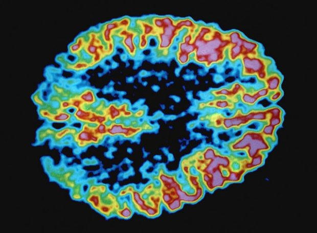 Снимок мозга больного синдромом Альцгеймера, сделанный в позитронно-эмиссионом томографе.