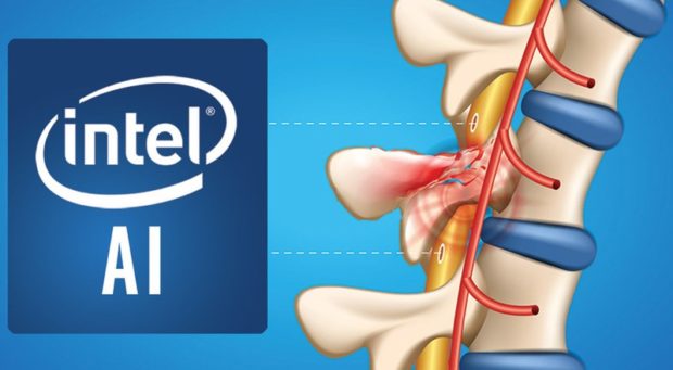 Нейросеть Intel готовится заменить парализованным спинной мозг