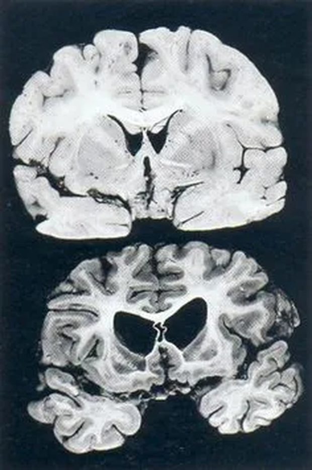Срез мозга здорового человека (вверху) и мозга человека с болезнью Гентингтона (внизу)