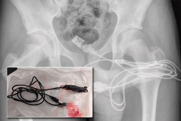 Хирурги удалили из уретры подростка USB-кабель