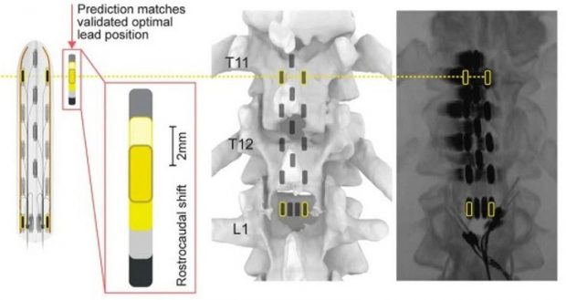МРТ и КТ позволяют создать трехмерную и полно информативную модель задних корешков спинного мозга