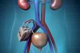 Kidney Project имплантируемая искусственная почка