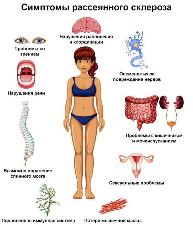 В России растет число пациентов с рассеянным склерозом