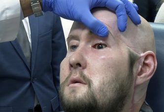 Трансплантация донорского глаза, нервов и части лица