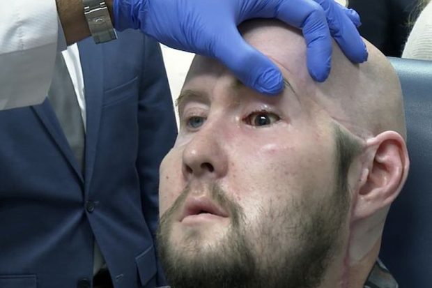 трансплантация донорского глаза, нервов и части лица